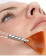 Peeling Chimique